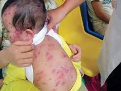 Dịch sởi đã lan trên 59 tỉnh thành