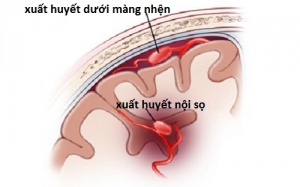 Bệnh xuất huyết mạch não dạng bột