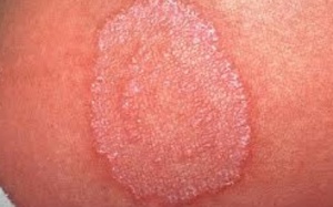 Vì sao bệnh hắc lào hay tái phát?