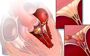 Khi nào nên tiêm phòng thấp tim?