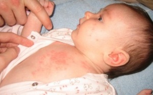 Cách trị rôm sảy cho trẻ