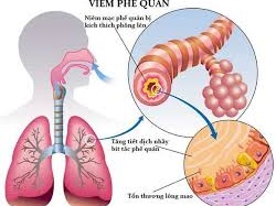 Điều trị viêm phế quản cấp ở trẻ?