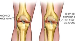 Thoái hóa khớp gối - gánh nặng y khoa