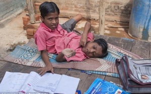 Ấn Độ: Cặp song sinh dính liền thắt lưng không muốn tách rời