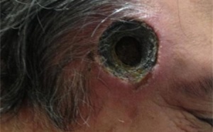 Người đàn ông thủng đầu vì thuốc tẩy nốt ruồi