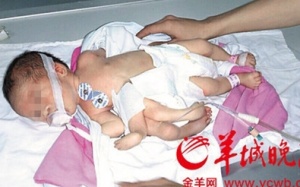 Trung Quốc: Phẫu thuật bỏ chi thừa cho bé sơ sinh 8 chi