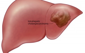 Tế bào lympho T giúp chữa khỏi ung thư gan