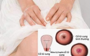 Lộ tuyến cổ tử cung có thực lành???