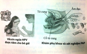 Cấp bách vấn đề dự phòng - điều trị ung thư cổ tử cung