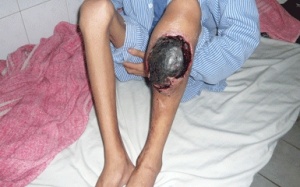 Hơn 6.000 người Việt mắc 'căn bệnh hoàng gia'