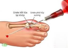 Tác dụng phụ của thuốc chữa gút