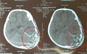 Bé 18 tháng tử vong vì bị tivi đè