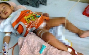 Cần tái tạo gấp bàng quang cho bé Anh Đức