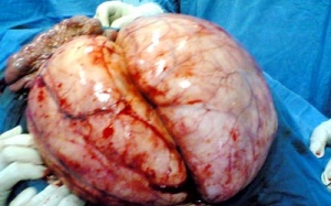 Phẫu thuật tách khối u lồng ngực “khủng” hiếm thấy