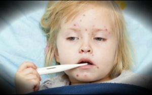 Dịch sởi: Bùng phát không chỉ ở Việt Nam