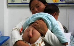 Trung Quốc: Bé 5 tháng tuổi có 'đuôi' dài 13 cm