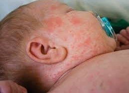 Chăm sóc trẻ nhiễm sởi đúng cách tại nhà