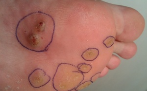 Cách nào hạn chế tái phát chai chân?