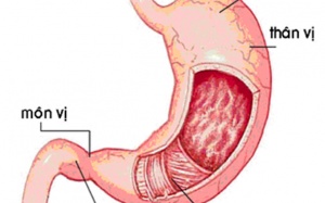 Xung huyết hang bị dạ dày, dùng Bảo Vị An thế nào cho hiệu quả?
