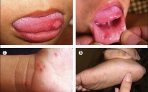 Biến chứng bệnh tay chân miệng có thể tử vong