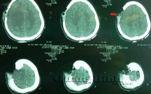 Chờ ghép lại, mảnh xương sọ được nuôi bằng bụng