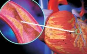 Ngăn ngừa xơ vữa động mạch bằng phong tỏa phân tử mỡ và đường