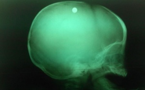 TP. HCM: Chị gái nghịch súng, bé trai 6 tháng tuổi bị bắn vào đầu