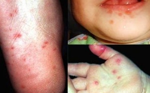 Dịch tay chân miệng đã xuất hiện tại 62 địa phương