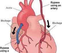 Nguy cơ biến chứng tim mạch do Ðái tháo đường