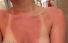 Chăm sóc da bị cháy nắng mùa hè