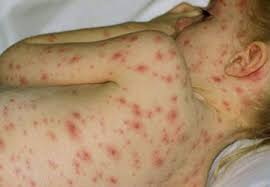 Người bệnh thủy đậu thì không nên ăn...