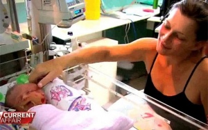 Đau lòng bé sinh ra có hai đầu, chung một bộ não