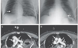 Người đàn ông có trái tim 'dạo chơi' trong lồng ngực