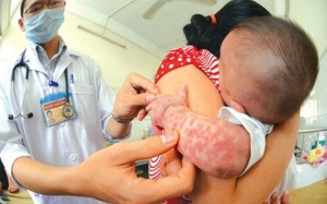Thêm một trẻ tử vong do sởi tại Bệnh viện Nhi Trung ương