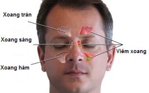 Biến chứng của viêm xoang?