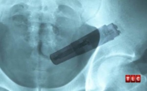 Người đàn ông bị mắc kẹt sex-toy trong ruột già