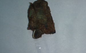 Tìm thất khung răng giả sau 20 năm nằm trong phế quản