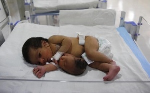 Đầu mọc từ bụng bé sơ sinh