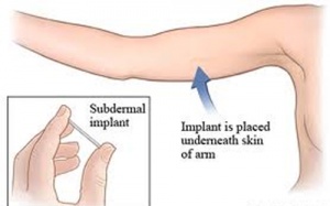 Người bị ung thư vú không nên dùng que cấy tránh thai?