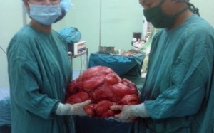 Phẫu thuật lấy khối u 11kg trong ổ bụng bệnh nhân