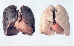 Ung thư phổi: Phát hiện muộn, tử vong nhanh