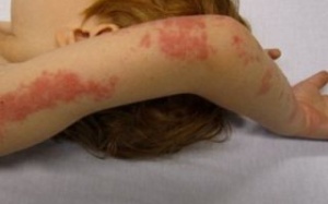 Bệnh giời leo do virus thủy đậu