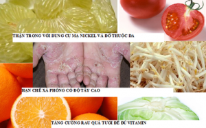 Hạn chế sự khó chịu của bệnh á sừng