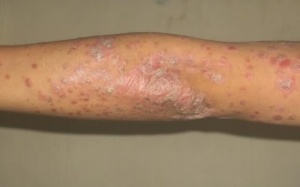 WHO công nhận vẩy nến là bệnh nguy hiểm