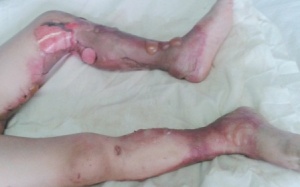 Điều trị thành công bé 6 tuổi bỏng nặng 56% cơ thể