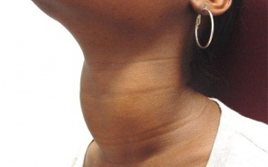 Một số bài thuốc trị bướu cổ do rối loạn tuyến giáp