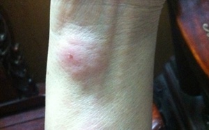 Chuyên gia bày cách phòng chống bọ xít hút máu