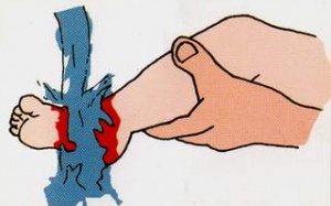 Cách đơn giản xử trí khi trẻ bị bỏng?