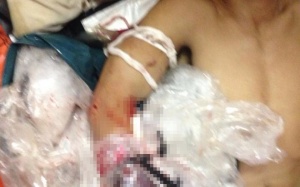 Đứt lìa cánh tay khi đang đánh cá trên biển