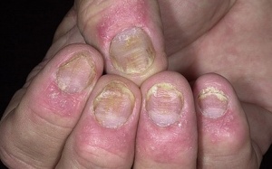 8 nguyên nhân chính gây ra bệnh vẩy nến